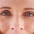 what you need to know before having eyelid surgery